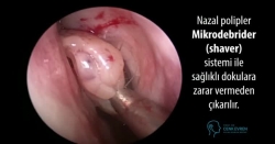 nazal polip operasyonu